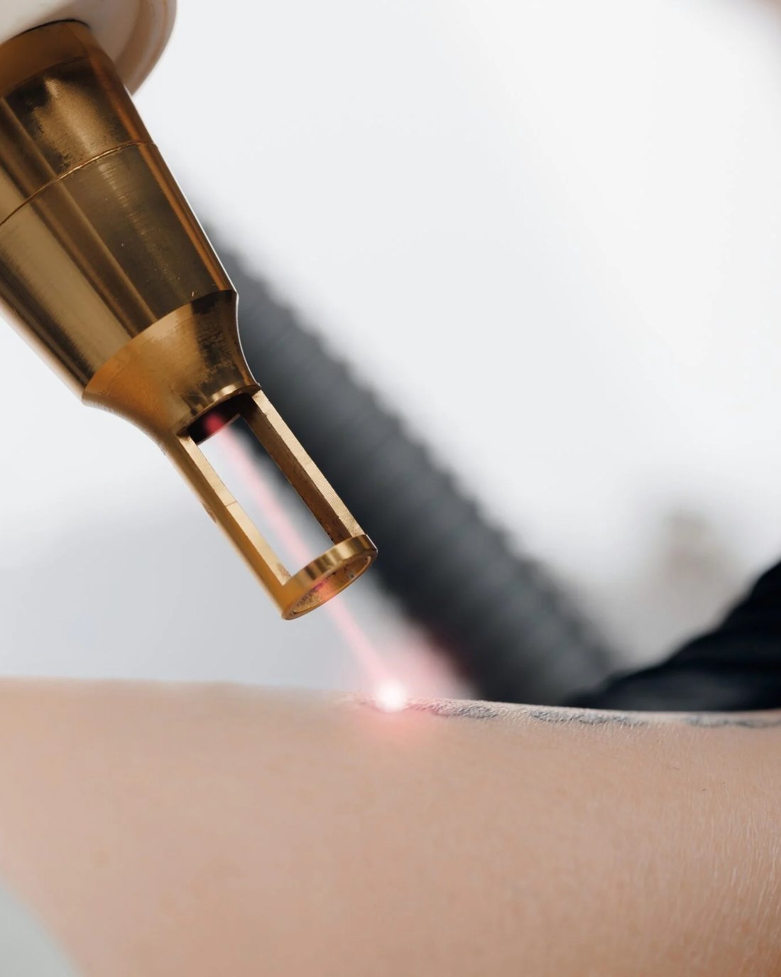 Laser tattoo removal in progress, close up